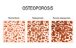 Osteoporosis - is a disease of bones that leads to an increased risk of fracture.