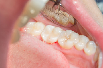 close-up of a human rotten carious tooth at the treatment stage in a dental clinic