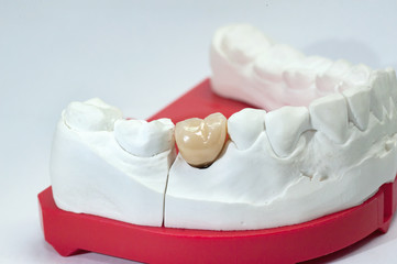 Gypsum dental model with ceramic tooth