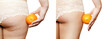 Female buttocks and orange, white lace panties, after a medical procedure, beautiful female pop, skin defects, solution, closeup, cellulite