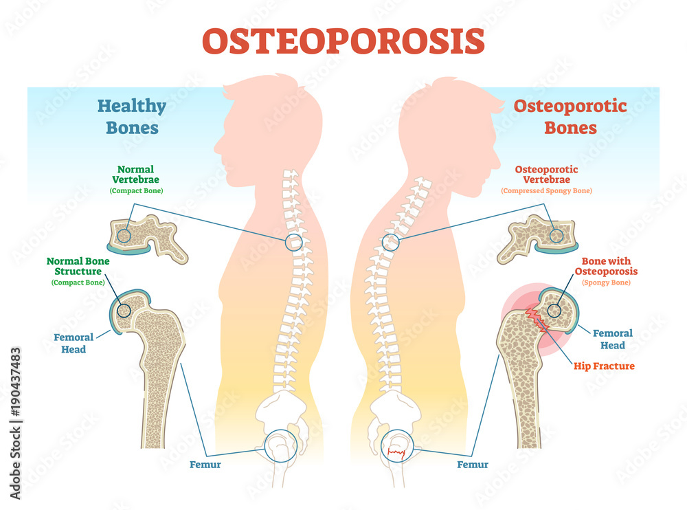 Osteoporosis examples vector illustration diagram with bone density.  - obrazy, fototapety, plakaty 