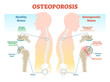 Osteoporosis examples vector illustration diagram with bone density. 
