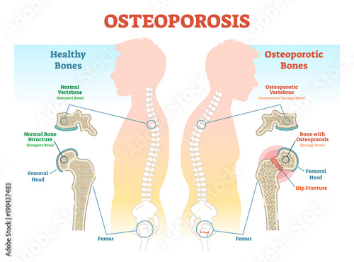 Fotografía Osteoporosis examples vector illustration diagram with bone density