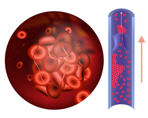 Wall Mural - Prothrombin thrombophilia. (sometimes hypercoagulability or a prothrombotic state) 