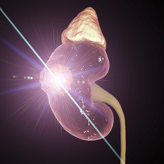 Poster - Treatment of kidney cancer with laser, conceptual image. 3D illustration. Concept of laserotherapy of tumors