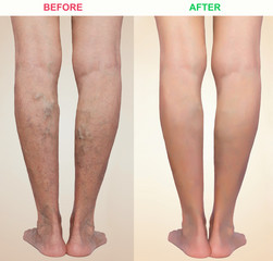 Wall Mural - Treatment of varicose before and after. Varicose veins on the legs.