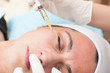 © aerogondo - close up of a young woman having mesotherapy treatment