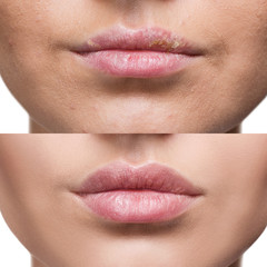 Lips with herpes before and after treatment.