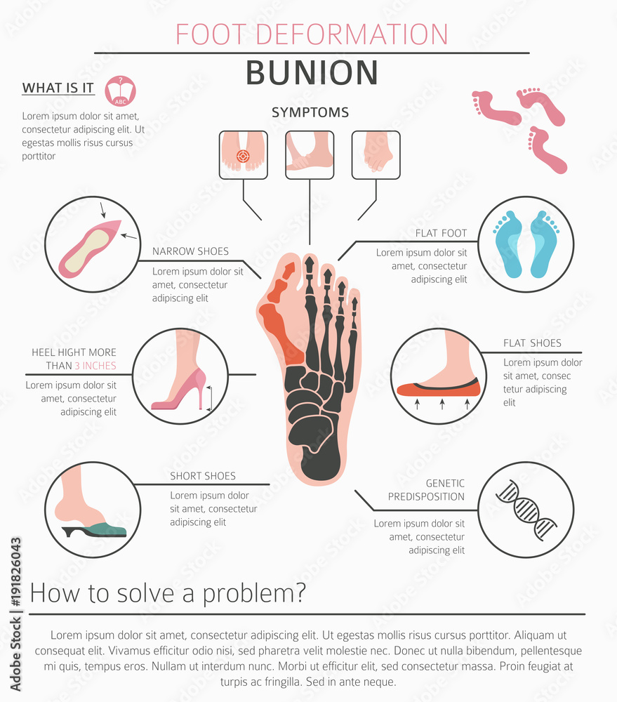 Foot deformation as medical desease infographic. Causes of bunion Stock ...