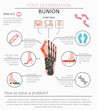 © a7880ss - Foot deformation as medical desease infographic. Causes of bunion