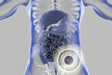 Sticker - Colorectal cancer awareness medical concept. Concept of cancer treatment and prevention, 3D illustration