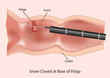 Polypectomy using colonoscopy