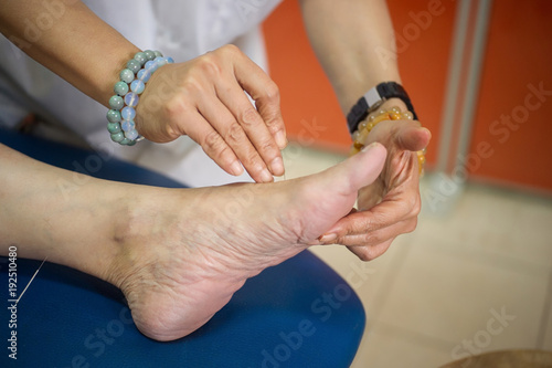 Fotografie, Obraz Closeup of hand performing acupuncture therapy.