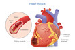 Illustration of Arterial thrombosis is a blood clot that develops to heart attack. Causes and risk factors for health problem.