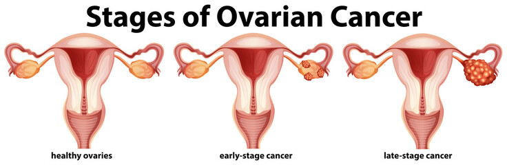 Wall Mural - Diagram showing stages of ovarian cancer
