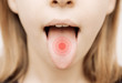 Lingua arrossata, bocca aperta con bollo rosso
