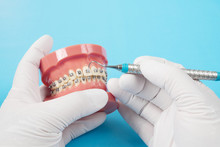 Orthodontic Model And Dentist Tool - Demonstration Teeth Model Of Varities Of Orthodontic Bracket Or Brace
