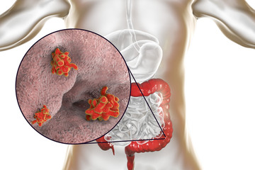 Poster - Entamoeba histolytica protozoan infection of large intestine. Parasite which causes amoebic dysentery and ulcers. 3D illustration