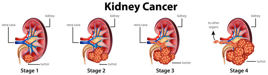 Wall Mural - Diagram showing different stages of kidney cancer