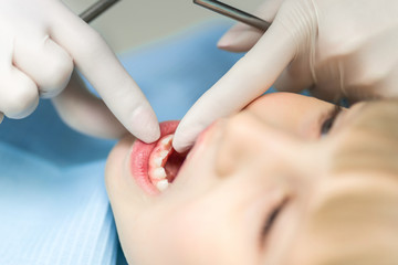 Close-up dentist hand showing milk teeth and molar. Replacemnet of baby tooth with permanent. Hole after tooth fell out. Growing of children teeth