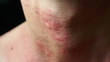 © YSTUDIO - Macro image of symptoms of itchy urticaria or rash