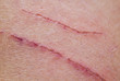 © nataba - two shallow inflamed scratches on human skin
