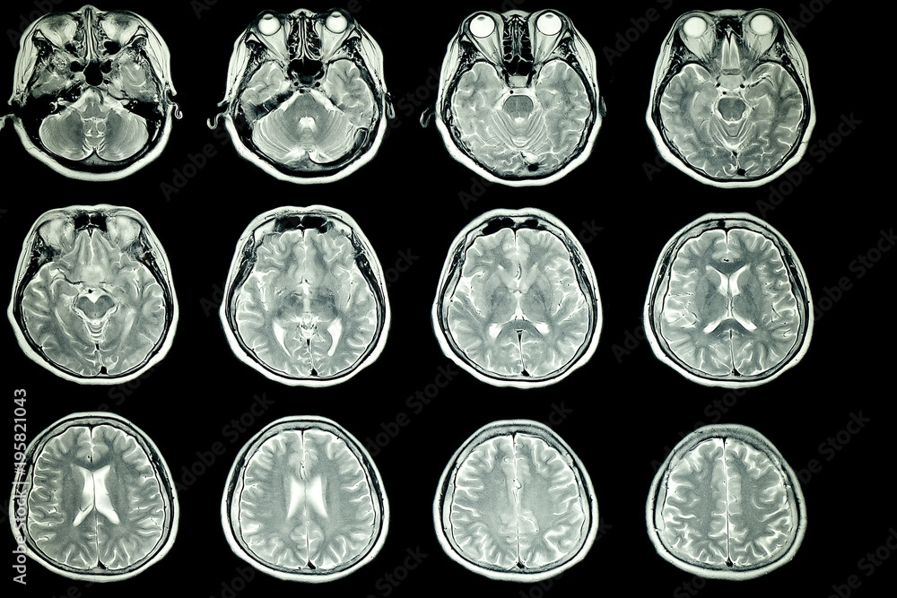 MRI scan of patient brain Stock Photo | Adobe Stock