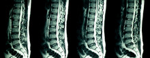 MRI Scan Of Lumbar Spines Of A Patient With Chronic Back Pain.