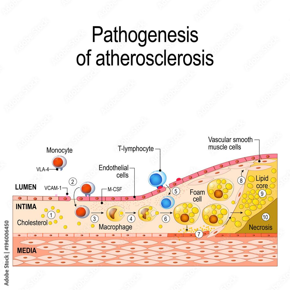 Pathogenesis of atherosclerosis Stock Vector | Adobe Stock