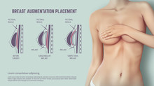 Diagram About Method Of Insertion For Breast Implant. Plastic Surgery Of Breast Implants Illustration.
