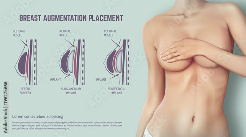 Cuadros en Lienzo Diagram about method of insertion for breast implant