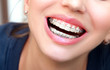 Closeup female smile with ceramic braces teeth.
Orthodontic treatment.