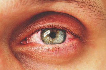 red eye of a patient with human conjunctivitis, retro toned