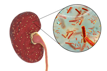 Poster - Acute pyelonephritis, medical concept, and close-up view of bacteria, the common causative agent of kidney infection, 3D illustration