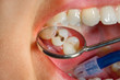 © Сергей Кучугурный - Dental treatment in dental clinic. Rotten carious tooth macro. Treatment endodontic canals