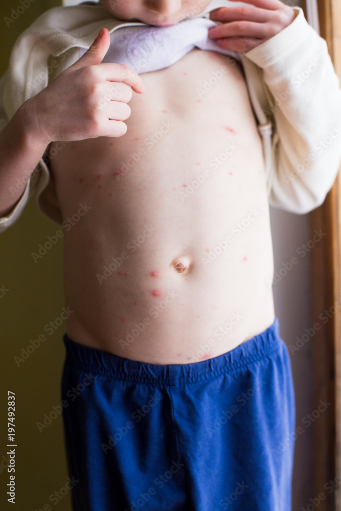 Baby with chicken pox rash. Varicella virus or Chickenpox bubble rash ...