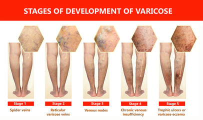 Wall Mural - Varicose veins on a female senior leg