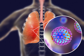 Sticker - Flu viruses in human lungs, 3D illustration showing anatomy of human respiratory system and close-up view of influenza virus inside lungs