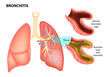 
BRONCHITIS. Normal bronchial tube and
Bronchial tube with bronchitis. Vector illustration of lungs affected by bronchitis