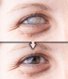 Fototapeta  - Eye with cataract and corneal opacity before and after surgery
