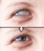 Eye With Cataract And Corneal Opacity Before And After Surgery
