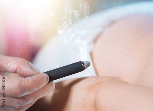 Fotomural smoking moxa stick therapy. TCM Traditional Chinese Medicine.