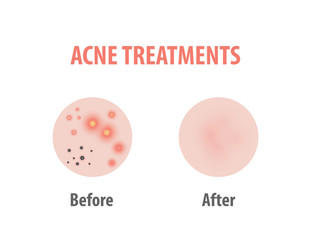 Wall Mural - Acne treatments diagram illustration vector on white background, Beauty concept.