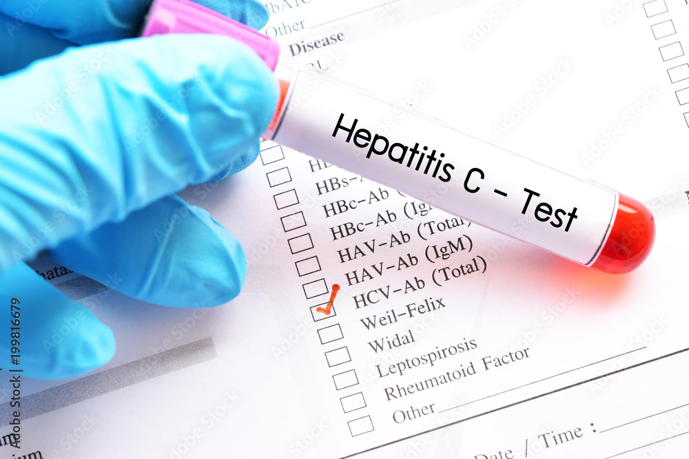 Blood sample for hepatitis C virus (HCV) test - obrazy, fototapety, plakaty 