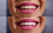close up of smile with white teeth before and after .
