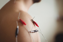 Close-up Of Patient Getting Electro Dry Needling
