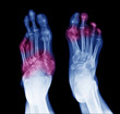 X-ray image of diabetic feet, posterior view show amputation toes and joint inflamed