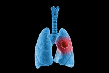 3d x-ray of a human lungs cancer. part of anatomy human body model with organ system.