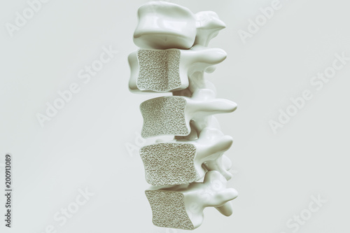Fotografía Osteoporosis on the spine - 3d rendering