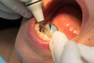 Wall Mural - A dentist makes teeth to a woman